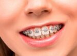 Врач Балакирева: самостоятельное снятие брекетов грозит кариесом и нарушением прикуса