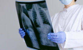 Британец пробежал несколько километров со сломанным в трех местах позвоночником