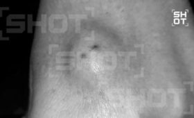 SHOT: большая шишка выросла у россиянки после укуса паука в Египте