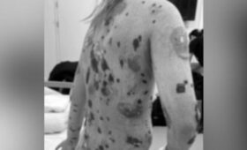 Врачи в Подмосковье помогли девочке с тяжелым поражением кожи после приема лекарства