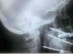 Волгоградские врачи спасли рыбака, ранившего себя гарпуном в лицо
