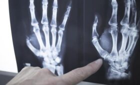 Врач Кусевич: привычка пользоваться смартфоном одной рукой может деформировать кисть