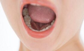 Травматолог Апанасюк: отлепить примерзший язык от металла можно приемом «домик»