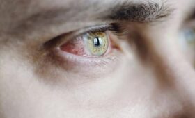 Врач Шилова: поллинозный конъюнктивит чреват травмами слизистой глаза